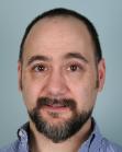 Before Hair Transplant &nbsp;Front